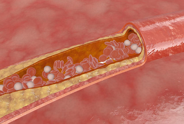 動脈硬化是如何形成的？又該怎樣預(yù)防呢？